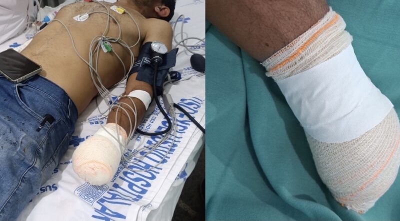 Homem tem mão decepada por mototaxista após briga por cerca de terreno em Campo Maior