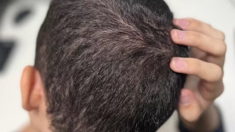 Volta às aulas aumenta casos de piolhos em crianças; veja como identificar e tratar