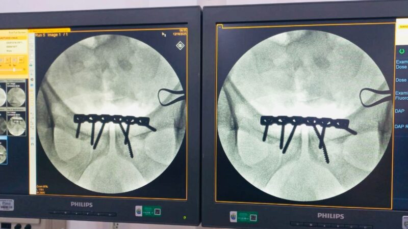 Hospital de Piripiri realiza, pela primeira vez, cirurgia ortopédica de alta complexidade em paciente com fratura de bacia